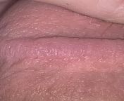 Does this look like genital warts, or maybe fordyce spots? from fordyce jpg