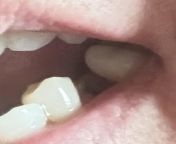 I went to the dentist for a cleaning today. The dental hygienist was too rough and somehow pulled one of my crowns off, while cracking the remaining enamel so now I have to get a Dental Implant, which will cost thousands out of pocket, even with insurance from dental tam