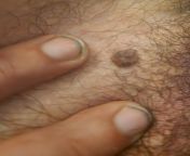 Is it a wart or a mole? How can I remove it at home? NSFW bc no no square. from haji no modotte