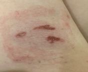 Any idea what degree these burns are? Dropped a high-heat small craft iron on my thigh... top two are non-painful/numb to touch, bottom one is painful and skin around all of them is very painful. Disregard the red square, Im sensitive to bandage adhesive from painful desiri