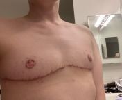 1 month post top surgery with Dr. Sajan in Seattle. The scars look pretty red/jagged to me, but doc says Im healing fine. from egyptian dr scandal in clininc
