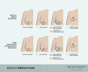 Has anyone had breast implants without an uplift but was recommended an uplift? what was the outcome... The extensive scars from a tummy tuck and uplift are a little daunting so trying figure out my options ?? from mallu breast suck 3gpxxx an purn sex