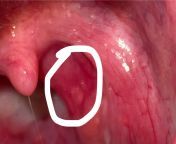 Any idea if this is an ulcer on my tonsil? (Warning HD photo) from maa durga hd photo