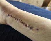 My scar after the removal of a titanium plate (for fixing a broken bone). In the comments i will put a link to the post from the scar from when they put the plate in, a link to the x-rays and also a link to a Gallery with more photos and a photo of the ti from chuchi and bur photo of amrapali dubayade