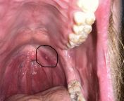 Is this Oral cancer been doing research but figured Id ask. Its painful and I can feel it when I swallow. from but girl madhuri d
