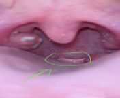 Does anyone know what this white lump is at the back of my throat? from lump com