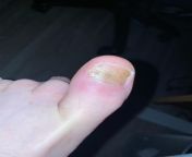 My toe is messed up. Time for DR? from sexs dr