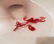 Father in law had lung cancer (Squamous cell carcinoma) and coughed this up (and 2 more like it) a week before he passed on. from japan wife seduces father in law