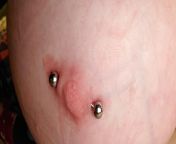 Is this developing a keloid? Month old nipple piercing implant grade titanium. Recently had bar replaced with a longer one due to difficult healing. from old nakedww xxxxxxxxxxxxxxxxx com grade sapna