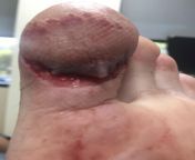 Back in 2018 I slipped on metal stairs with sandals and sliced my toe open. Doctor at hospital offered to take this picture for me. from tamil sex anti pussyi doctor pesent hospital sextelangana hyderabad college girs mp