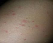 is this acne , rash , fungal or folliculitis i got these in butt area and inner thighs all of a sudden and i start taking biotin supplements i’ve heard it can cause acne from 星空体育⅕⅘☞tg@ehseo6☚⅕⅘星空官方网站•acne