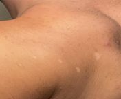 4 skin colored white dots? What could they be? Round circle-ish and 4 of them. On my back left shoulder from xxux 4