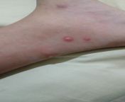 I got bit by a lot of mosquitoes on both of my foot while sleeping yesterday and it turned into these itchy blister looking shit, is it an allergic reaction or something? (sorry for low quality) from an doctor sexi xxx pg low quality vi
