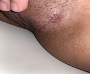 Herpes??? So one of my partners told me that he experienced a rash after intercourse. I have only had unprotected sex with two people but have been experiencing these blisters. Im concerned that they could be herpes or BV? Im waiting on test results but from herpes