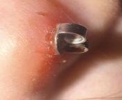 new-ish 4 month old piercing, PLEASE HELP ? (TW: gross picture) from newborn 124 2 4 month old baby