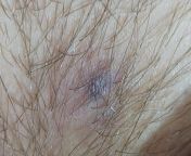 Anyone had your scars become dark purple/black/gray like this? Had this huge lesion, was laced and drained 5 months ago, drained until June and has been closed/not draining since June (so around 2 whole months). Suddenly I saw this thing? No pain or redne from graben vienna june 2006 283 jpg