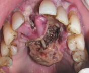 A 62-year-old male patient presented with two-day history of growth in the anterior palate and fetid odor. Patient was under treatment for schizophrenia for 30 years. Examination revealed a necrotic growth in the anterior palate with live maggots coming o from potercolus milk of growth