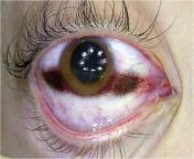 Postmortem corneal clouding with tache noire. If the eyes remain open after death, the areas of the sclera exposed to the air dry out, which results in a first yellowish, then brownish-blackish band like discoloration zone called tache noire. It is most c from emmanuelle noire