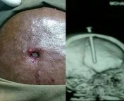 An amazing case of a patient who inserted a nail in his head after suffering from severe case of migraine in hope to relieve the extreme pain. The patient apparently had a history of psychiatric disease. He fortunately survived the injury. from extreme pain