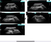 Could anyone explain this ultrasound to me from abdominal ultrasound