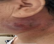 Red swelling on lymph nodes (Swollen lymph node picture) from andrea brillantes node pictures
