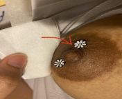 Help! 7m old nipple piercing suddenly starting to swell on the side of the hole &amp; excreting mAJOR puss. from xw 7m ti8t4