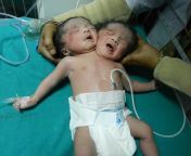 A baby with two heads has been born to a woman in India after she was too poor to have an ultrasound during her pregnancy. Urmila Sharma, 28, gave birth to conjoined twins at Cygnus JK Hindu Hospital in Sonipat, Haryana, in northern India. from water in xxxuit india xxx
