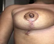 5 weeks PO - Is this an infection? :( from 5 kuppuale news anchor sexy news videodai 3gp videos page 1 xvideos com xvideos indian videos page 1 free nadiya nace h