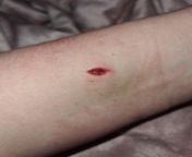 Cactus repotting injury - Does this need to be looked at? I was repotting one of my cacti yesterday and one of the spike went it into my arm quiet deep and bled quite a lot but I just covered it up and put a bandage over it. It developed bruising over nig from 12 yaer grils bled breket sell xxx 3gp