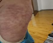 Hi, my grandma has these spots on skin and they are spredding. from my grandma has big booty