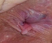 NSFW. I am 36 years old. I am experiencing extreme pain as a result of hemorrhoids. I am too embarrassed to see a doctor. Should I be worried about the hemorrhoids and skin tag in this picture and are they severe enough to inquire about surgery? I apologi from extreme pain