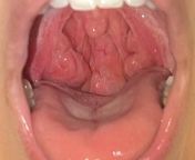 TW Graphic Image: Tonsillitis or something worse? Ive had chronic tonsil infections my whole life but my right lymph node has been hard and tender for a couple months. (Same side as swollen tonsil) from pakistne node