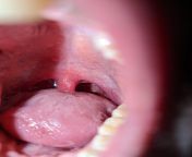 19M What is this weird spot on my uvula? from uvula nnyo wa nyovha