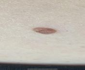 Mole changes during pregnancy....this mole was perfectly round and dark brown. It is losing its color and enlarging. It is on the side of my growing belly. Do you think this is because it is being stretched? Or is this suspicious? from beauty mole