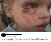 Family members Pitbull bites little girl on the face (27 June 2012, USA) from sundar uttalakkadipamba june 2012
