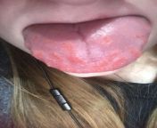 Hi again guys, I ate a foggin Sourpatch kids candy cane and My tongue did this, Im used to the burn marks after I eat sour food because I used to burn my tongue all the time, but this time the sour candy cane GAVE ME B U M P S? from all anemal an sex m p 4 vi