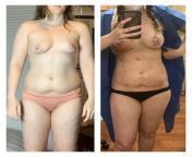 NSFW 19 hours post op lipo to abdomen and flanks with breast fat transfer to left breast and right donut mastopexy from breast and vagina sucking