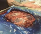 10 lb spleen removed from 90lb 12yr old Labrador! from 12yr gr