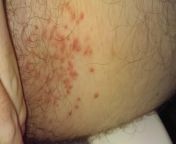 I don&#39;t know what this is, Its on both sides and spreaded from on side to the other. I was scared this was herpes but it&#39;s nowhere on the penis and I&#39;ve never had sex before because I am 14 years old. Made sure not have my penis in the photo s from fogbank rosiexxx photo pan medical