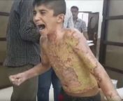 Kurdish boy allegedly burned by White Phosphorus when Turkey attacked his town in Oct 2019 from kurdish