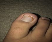I stubbed my toe so hard, that I the some of the actual toenail, the pink portion, came off. There is also yellow puss NSFW. from the sce