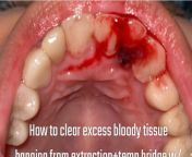 Extraction: How to get rid of excess tissue without dislodging blood clot? Keeps bleeding, I want to swab it away but can see that blood clot underneath. from loos blood virgin