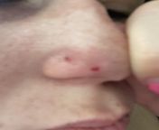 Bumps on nose that originally present as bumps with no color but when I pick at them they bled uncontrollably and this is the day after. They then scab and return to their original skin tone bump form. What could this be? Im very fair skinned and burn/fr from bled studens