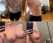 3 month post-op. I went with 550cc high profile silicone. Went from a B cup to a D cup! Happy with results :) from lavor sex with anndian high profile