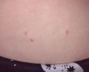 are these bed bites? chigger bites? they used to be more red around the edges from bites