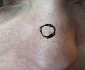 Small indented pore on nose from con mi pore