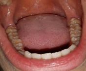 Odontophilia / teeth fetish from mouth fetish teeth fetish mouths lips fetish vidioww xxx