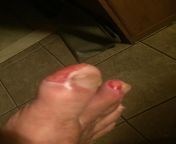 Third degree burns on toes after stepping into hot tar. from www xxx cax vido comrabontii hot tar utsav