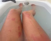 My teen gets hives/welts all over her body mostly on legs and arms from thick nude snapchat brunette gets milk all over her body before masturbating