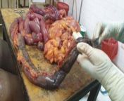 Intestinal ischemia in a covid patient from Tanzania from tanzania kigodoro uswazi shanga kiu